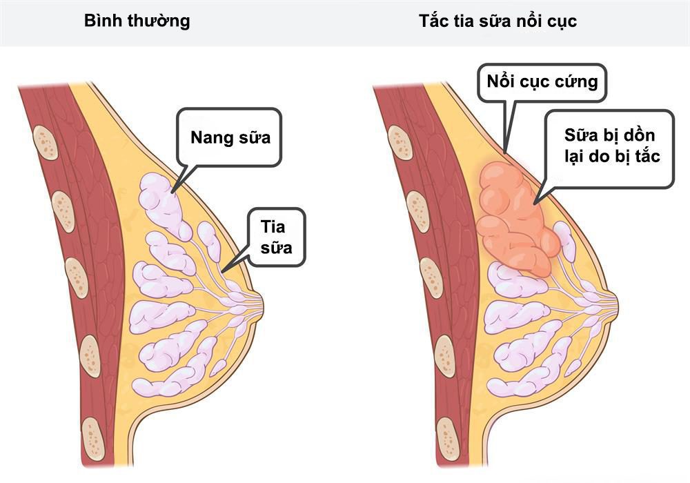 tac-tia-sua-dan-den-me-bi-giam-sua