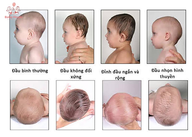 dau hieu tre bi meo dau