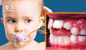 Bé ngậm ti giả có bị hô ? Cách dùng ti giả an toàn cho bé 19 tre-ngam-ti-gia-co-bi-ho-khong